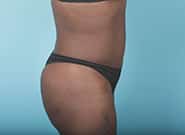After Image: Mesh Abdominoplasty - right-side