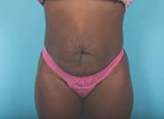 Before Image: Mesh Abdominoplasty - front
