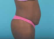 Before Image: Mesh Abdominoplasty - right-side