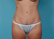 After Image: Mesh Abdominoplasty - front