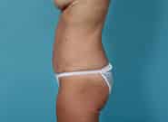 After Image: Mesh Abdominoplasty - left-side