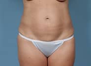 Before Image: Mesh Abdominoplasty - front