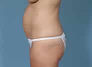 Before Image: Mesh Abdominoplasty - left-side