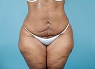 After Image: Mesh Abdominoplasty - front