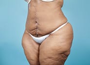 After Image: Mesh Abdominoplasty - left-front-oblique