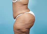After Image: Mesh Abdominoplasty - left-side