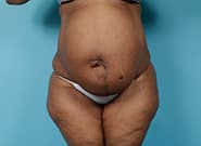 Before Image: Mesh Abdominoplasty - front