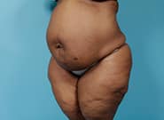 Before Image: Mesh Abdominoplasty - left-front-oblique