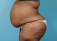 Before Image: Mesh Abdominoplasty - left-side