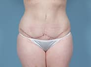 After Image: Mesh Abdominoplasty - front