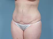 After Image: Mesh Abdominoplasty - left-front-oblique