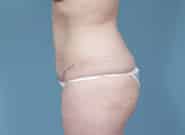 After Image: Mesh Abdominoplasty - left-side