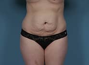 Before Image: Mesh Abdominoplasty - front