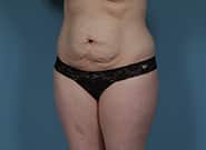 Before Image: Mesh Abdominoplasty - left-front-oblique