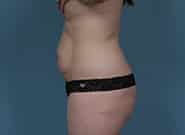 Before Image: Mesh Abdominoplasty - left-side