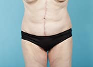 After Image: Mesh Abdominoplasty - front