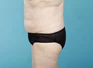 After Image: Mesh Abdominoplasty - left-side