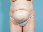 Before Image: Mesh Abdominoplasty - front