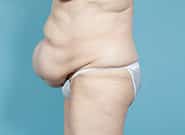 Before Image: Mesh Abdominoplasty - left-side
