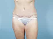After Image: Mesh Abdominoplasty - front