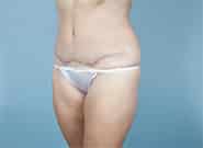 After Image: Mesh Abdominoplasty - left-front-oblique
