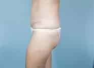 After Image: Mesh Abdominoplasty - left-side