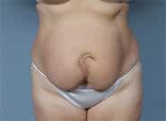 Before Image: Mesh Abdominoplasty - front