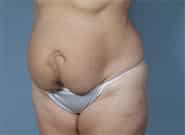 Before Image: Mesh Abdominoplasty - left-front-oblique