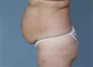 Before Image: Mesh Abdominoplasty - left-side