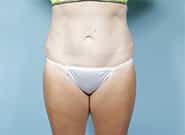 After Image: Mesh Abdominoplasty - front