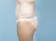After Image: Mesh Abdominoplasty - left-side