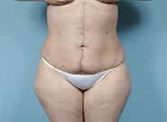 After Image: Mesh Abdominoplasty - front