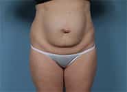 Before Image: Mesh Abdominoplasty - front