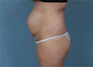 Before Image: Mesh Abdominoplasty - left-side