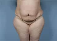 Before Image: Mesh Abdominoplasty - front