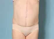After Image: Mesh Abdominoplasty - front