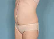 After Image: Mesh Abdominoplasty - left-front-oblique