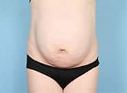 Before Image: Mesh Abdominoplasty - front