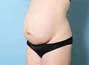 Before Image: Mesh Abdominoplasty - left-front-oblique