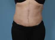 After Image: Mesh Abdominoplasty - front