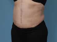 After Image: Mesh Abdominoplasty - left-front-oblique