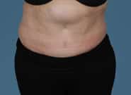 Before Image: Mesh Abdominoplasty - front