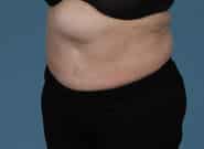 Before Image: Mesh Abdominoplasty - left-front-oblique