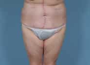 After Image: Mesh Abdominoplasty - front