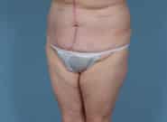 After Image: Mesh Abdominoplasty - left-front-oblique