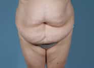 Before Image: Mesh Abdominoplasty - front