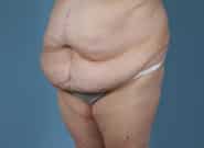 Before Image: Mesh Abdominoplasty - left-front-oblique