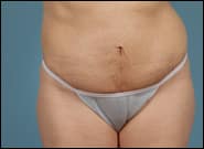 After Image: Mesh Abdominoplasty - front