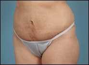 After Image: Mesh Abdominoplasty - left-front-oblique