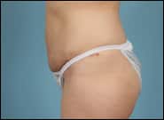 After Image: Mesh Abdominoplasty - left-side